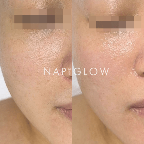 MTS Treatment + Gentle Peel Treatment x3 Package - Image 2