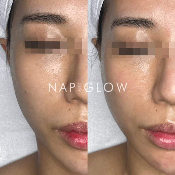 MTS Treatment + Gentle Peel Treatment x3 Package - Image 3