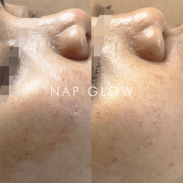 Skin Toning Therapy Treatment x3 Package - Image 2