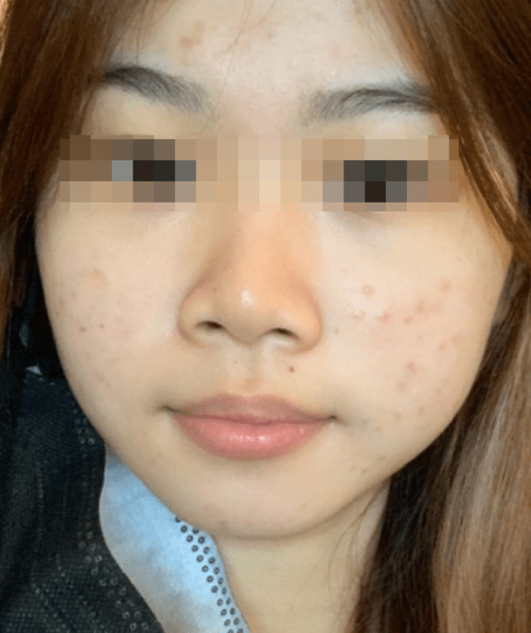 MTS Treatment + Gentle Peel Treatment x3 Package - Image 5