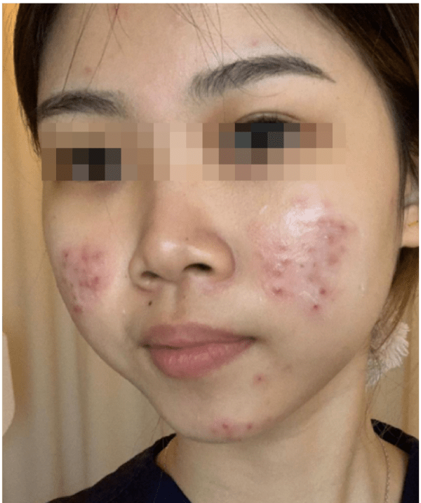 MTS Treatment + Gentle Peel Treatment x3 Package - Image 4