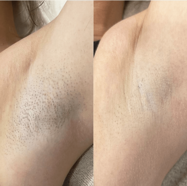 SHR Hair Removal - 8x Sessions (Full Legs) + FREE 8x SHR Brazilian - Image 2