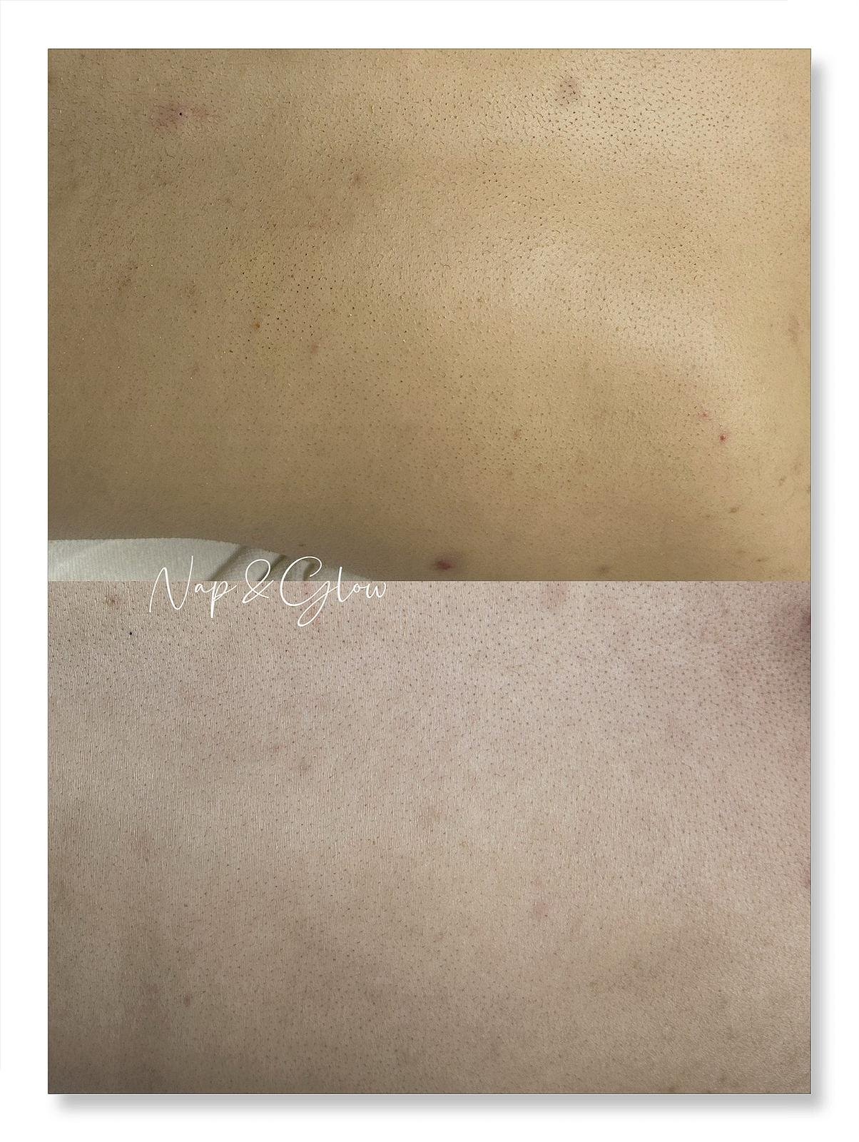 SHR Hair Removal - 8x Sessions (Full Legs) + FREE 8x SHR Brazilian - Image 3