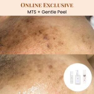 3x Sessions MTS Treatment + Gentle Peel and 8x Sessions SHR (Underarms) with 1x Snowflake Bundle