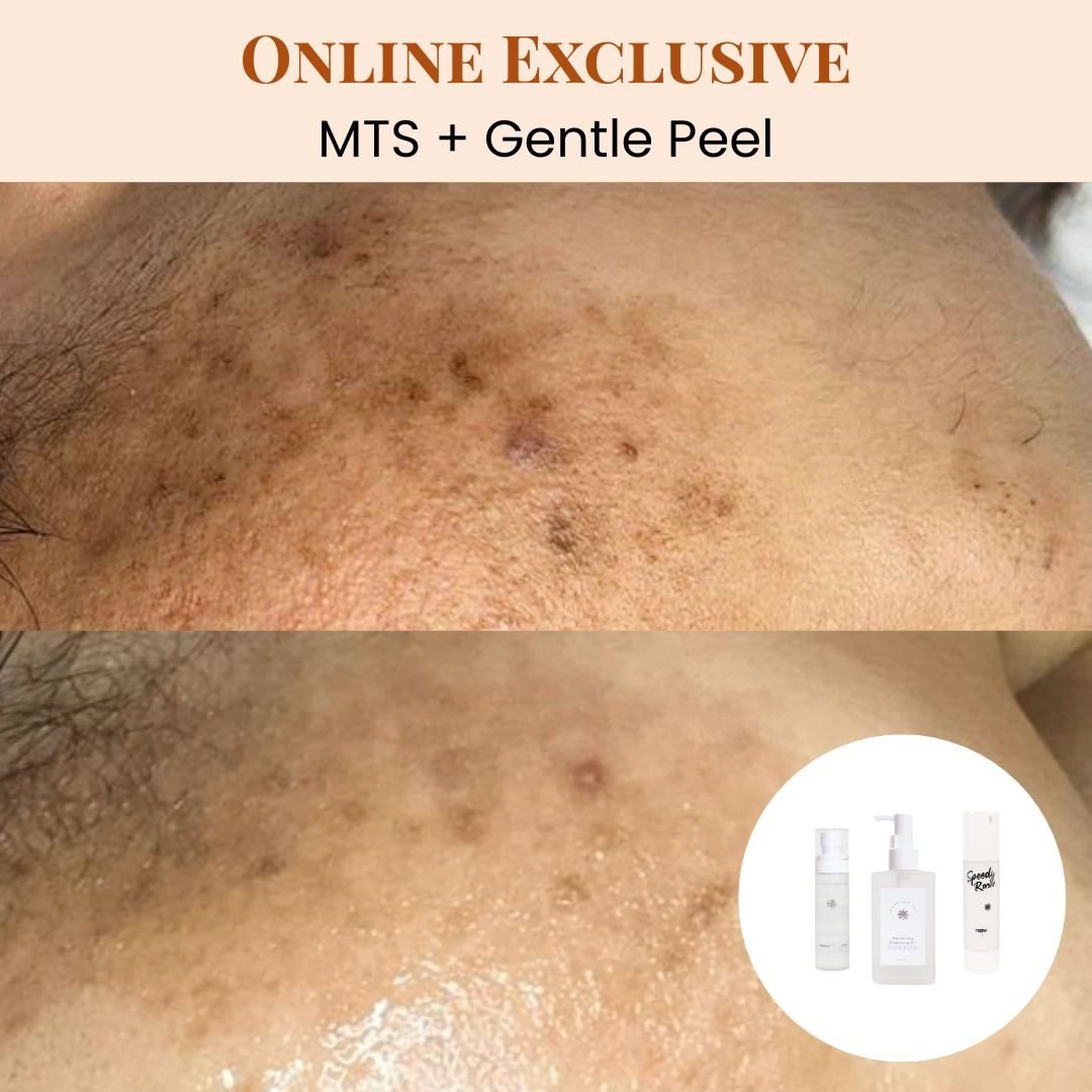 3x Sessions MTS Treatment + Gentle Peel and 8x Sessions SHR (Underarms) with 1x Snowflake Bundle